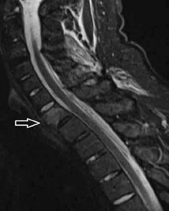 ploch, jsou osteofyty, starší pacienti trauma stress fraktura infekční sakroiliitida osteitis condensans ilii zdravý dobrovolník + děti edém většího rozsahu, atypická lokalizace edému, chybí