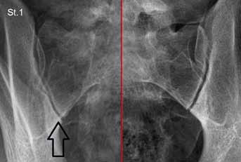 Obr. 4A Obr. 4B Obr. 4C Obr. 4D Obr. 4. Newyorská klasifikace, stupně 1 4; kostní změny označeny šipkami Fig. 4. Newyork classification, stage 1 4; bone changes are indicated by arrows ROLE JEDNOTLIVÝCH ZOBRAZOVACÍCH METOD RTG vyšetření RTG je základním zobrazovacím vyšetřením kostí.