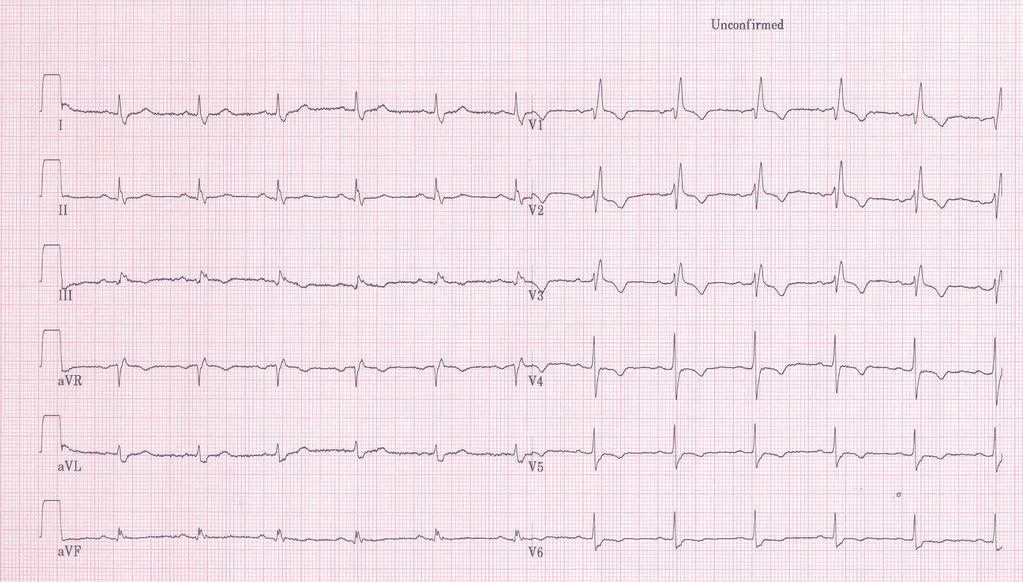 RBBB