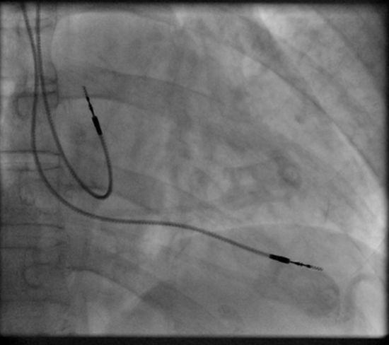 Technika výkonu Kožní řez, preparace kapsy podklíčková oblast Implantace elektrod