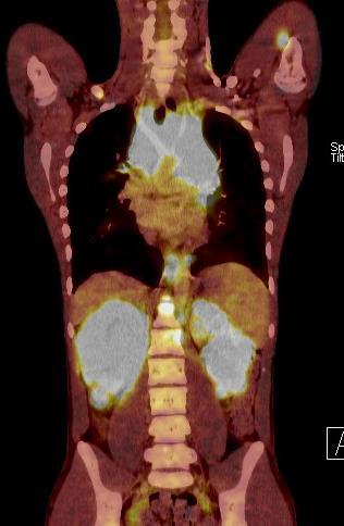 2 PET/CT exstirpace LU z