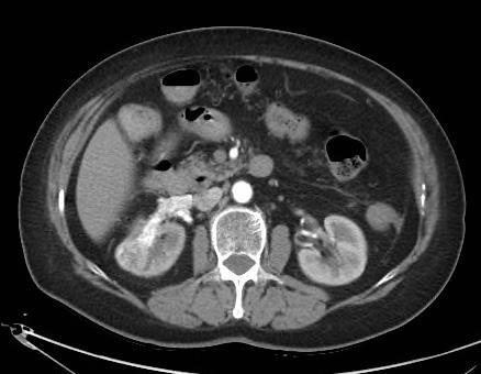 3 CT - maligní tumor s trombem v.