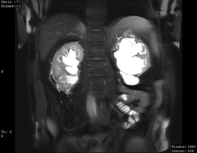 2015 Závěr: Parapelvické oboustranné cysty. V močovém měchýři cca 40ml. MR LEDVIN 8. 1. 2016 Indikace: Kontrolní MRI pro parapelvické oboustranné cysty.