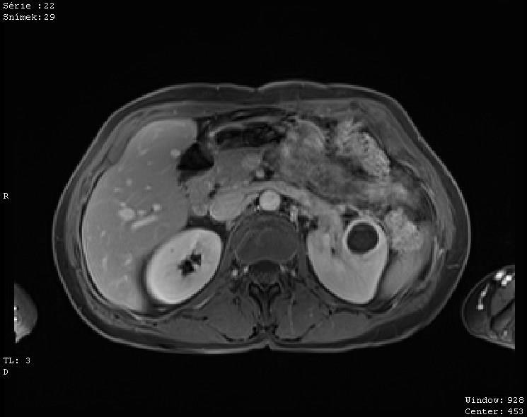 Obrázek 10: MR T1 VIBE fs Zdroj: FN Plzeň CT DRENÁŽ 11. 2. 2015 Drenáž abscesu ve ventrální části pars intermedia ledviny vlevo.