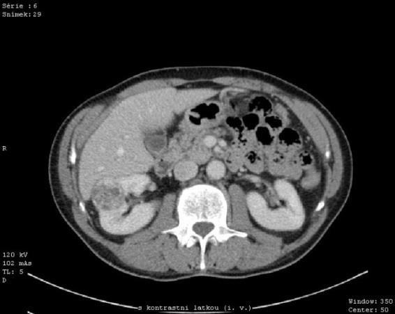 Obrázek 12: CT venózní fáze - axiální řez Zdroj: FN Plzeň CHIRURGICKÁ OPERACE 5. 9. 2013 Operace: Laparoskopická resekce tumoru pravé ledviny.