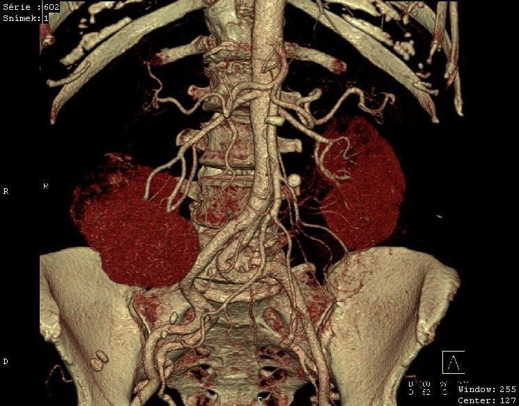 Závěr: Při dorzálním okraji horního pólu pravé ledviny objemný nekrotický tumor s neovaskularizací.