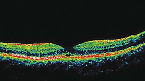 o zvýšení teploty až o 22 ºC. Fotochemické poškození vzniká také při pozorování slunce, které trvá déle než 90 sekund a to při úzké zornici. Existuje mnoho faktorů, které ovlivňují rozsah poškození.