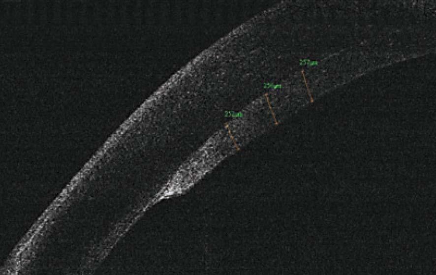 OCT schopné poskytnout důležitá měření rohovky, pachymetrické mapy, abnormality rohovkového rozhraní, a pomáhá také při ověření správného uchycení či odchlípení dárcovského štěpu. (Obr. 6-9 a Obr.