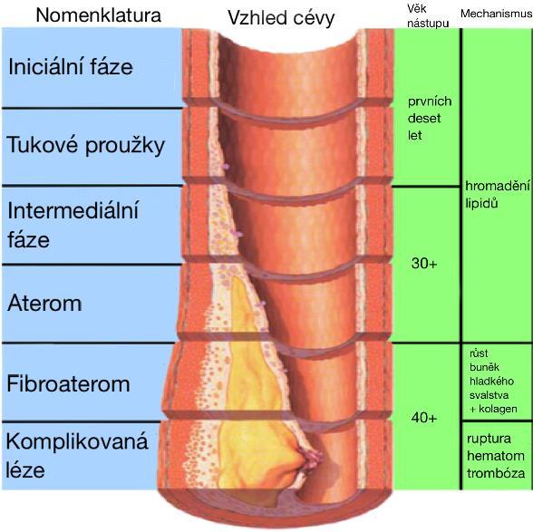 Obr. 4: Schéma jednotlivých fází aterogeneze (Grahams Child, 2006) 3.4 Stabilita aterosklerotického plátu Aterosklerotický plát je produktem dlouhého a komplikovaného procesu aterosklerózy.