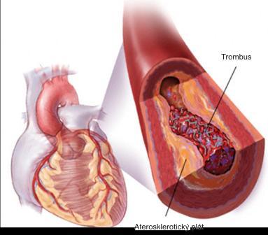 Neovlivnitelné rizikové faktory Věk Mužské pohlaví Genetické faktory Ovlivnitelné rizikové faktory Co je vysoký cholesterol? Co je vysoký krevní tlak?