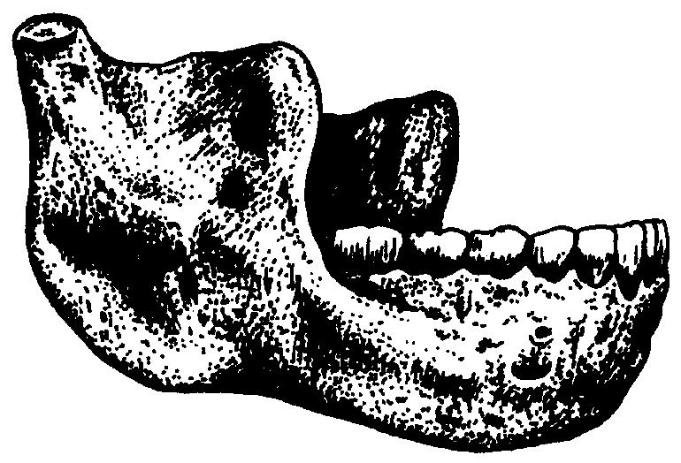Homo heidelbergensis (člověk heidelbergský; 0,9 0,2 Ma) V roce 1907 byla v pískovně u obce Mauer nedaleko Heidelbergu nalezena spodní čelist, nález byl popsán roku 1908 profesorem Schoetensackem jako