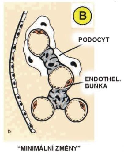 Glomerulopatie s minimálními změnami (lipoidní nefróza) Zejména u dětí Patogeneze nejasná souvislost s virovými infekcemi, imunizací, atopií, aplikací některých léků (antiflogistika) Výskyt spojený s