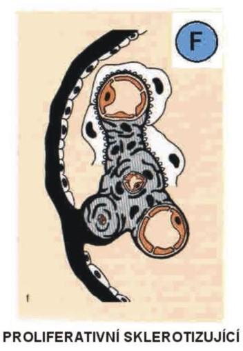 Chronická glomerulonefritis Společný konečný stav řady glomerulárních nemocí ( end stage kidney ) Charakterizována proměnlivým rozsahem