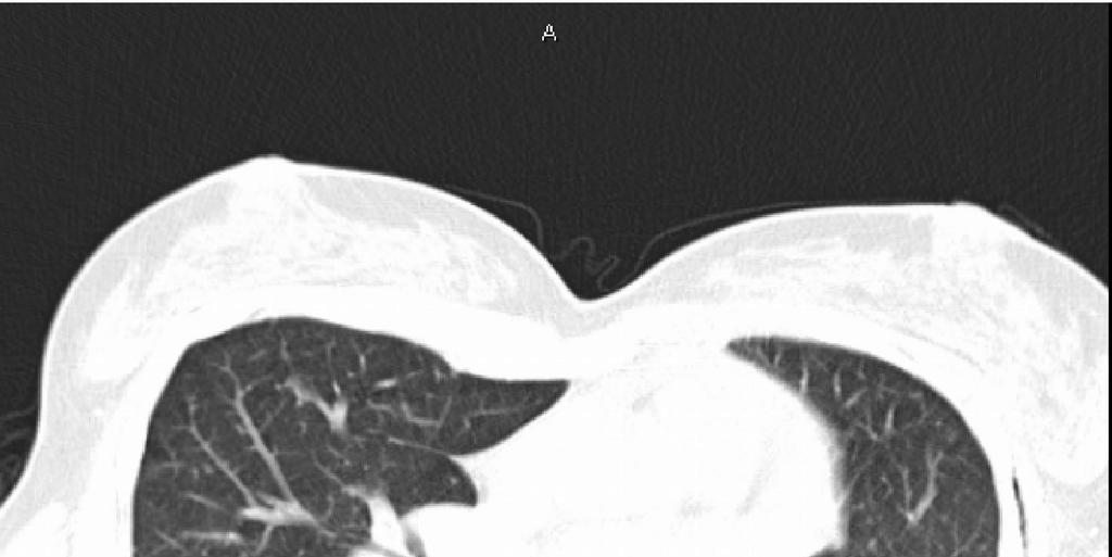 Obr. 2 HRCT nález pacientky s nitrohrudní sarkoidózou II.st (archiv autora) Funkční vyšetření Typickým nálezem je restrikční ventilační porucha.