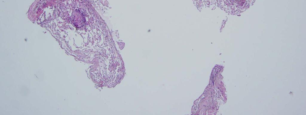sarkoidózou-granulom