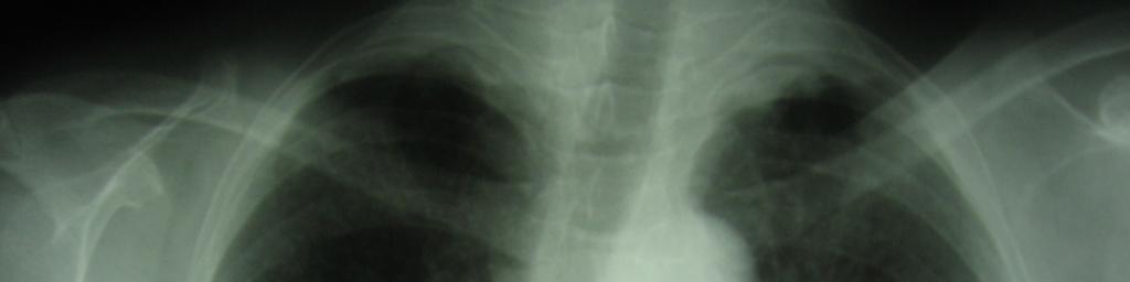 Obr. 5 Zadopřední skiagram hrudníku- chronická EAA (archiv autora) U akutně probíhající EAA bývá výraznější radiologický nález ve středních