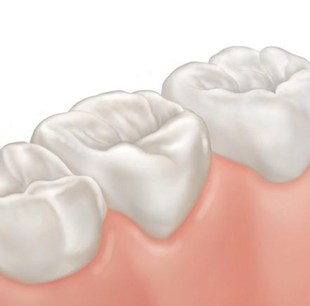 CO JE ZUBNÍ KAZ Bakterie zubního plaku mění cukry, které sníme na kyseliny, které škodí naším zoubkům. Pokud je necháme působit dostatečně dlouho... 1. Zdravé zuby s povlakem 2.