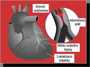Definice AKS: Onemocnění srdce, kam řadíme i diagnózy, sdružující se pod názvem Akutní koronární syndrom (AKS), jsou hlavní příčinou úmrtí v ČR.