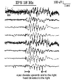 EEG in eyelid