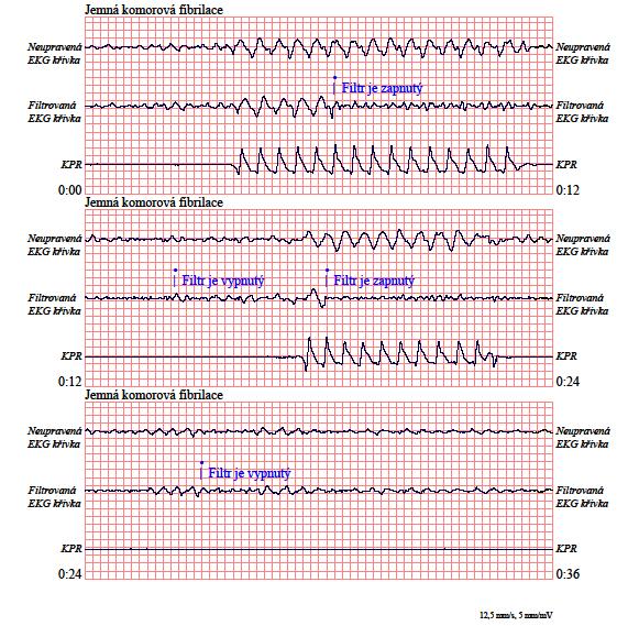 KAPITOLA 4 MANUÁLNÍ REŽIM Příklady Následující příklady ukazují účinky filtrování See-Thru CPR na signály EKG kontaminované artefaktem CPR. Každý příklad obsahuje: Signál EKG s artefaktem KPR.