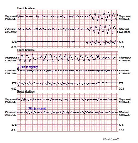 See-Thru CPR Obrázek 2 ukazuje pacienta s fibrilací komor, kterou lze během masáže rozeznat o něco obtížněji.