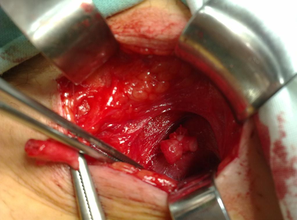 o d b o r n ý č l á n e k revaskularizačních zákroků je v současnosti metodou volby angioplastika se stentingem.