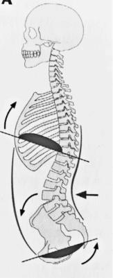 Hyperlordóza bederní páteře souvisí s oslabením břišního svalstva (m. rectus abdominis, m. obliquus externus abdominis, m. internus abdominis) a hýžďových svalů (m. gluteus maximus, m.