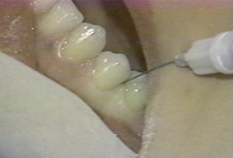 sledujícím textu. Navíc lze tyto postupy použít jako doplněk svodné anestezie, pokud nedošlo k úplnému znecitlivění (např. izolovaná oblast zubu je stále citlivá).