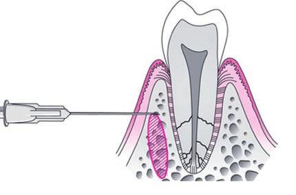 mandibulární anestezii. Krátká jehla (27 Gauge) s hrotem přivráceným k zubu je zavedena do gingiválního sulku meziálně u anestezovaného zubu a zavedena co nejhlouběji (obr. 6).