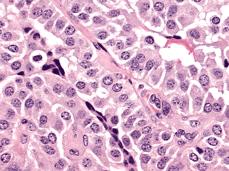 Obr. 7 Collumnar cell varianta [10] Columnar cell varianta má buňky s jemně rozptýlenými a hyperchomatickými jádry (Obr. 7).