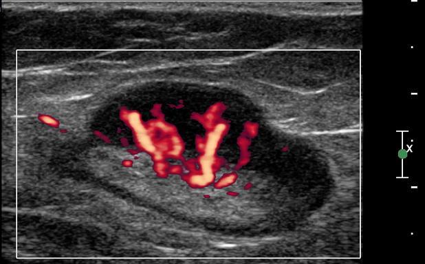 Echogenita Hypoechogenní nádorové i reaktivní LU Hyperechogenní uzliny krku u papilárního karcinomu štítné žlázy (depozita tyreoglobulinu) Metast Metastáza invazivního duktálního karcinomu prsu v