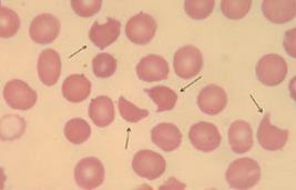 Rozšířená laboratoř Krevní obraz nátěr na sklo schistocyty v koncentraci >10/1000 erytrocytů (>1%, resp. >0,01) obvykle znamenají dg.