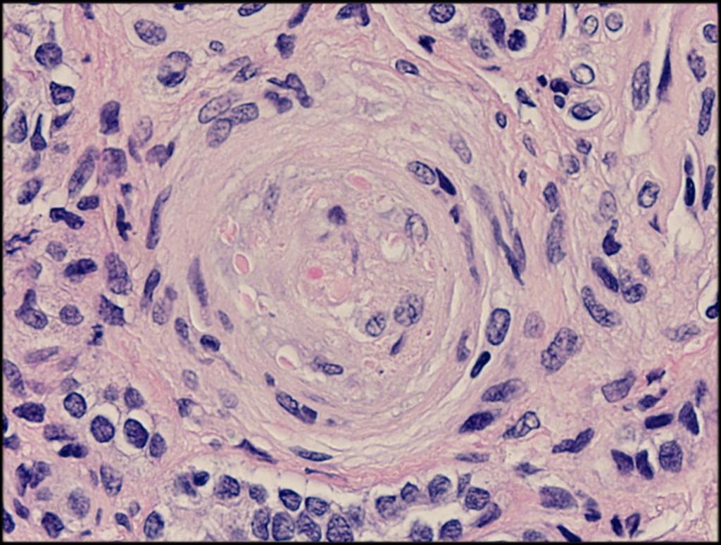 Histologický Je Arteriola patrná nález endotelióza je okludovaná je nakonec způsobená u fibrinovým všech depozity