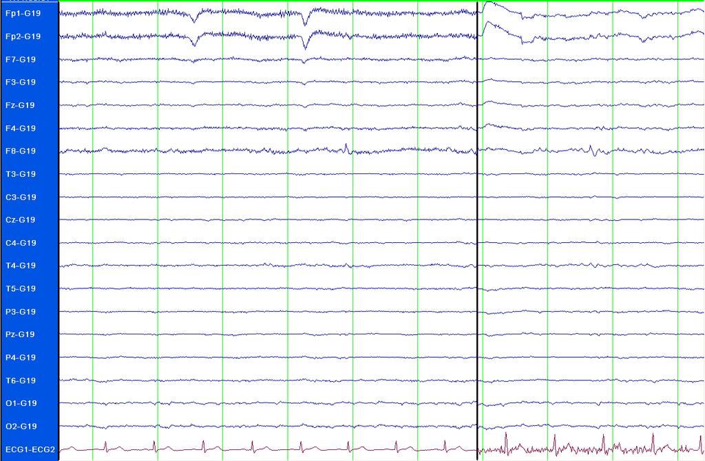 EEG u MTLE, bez