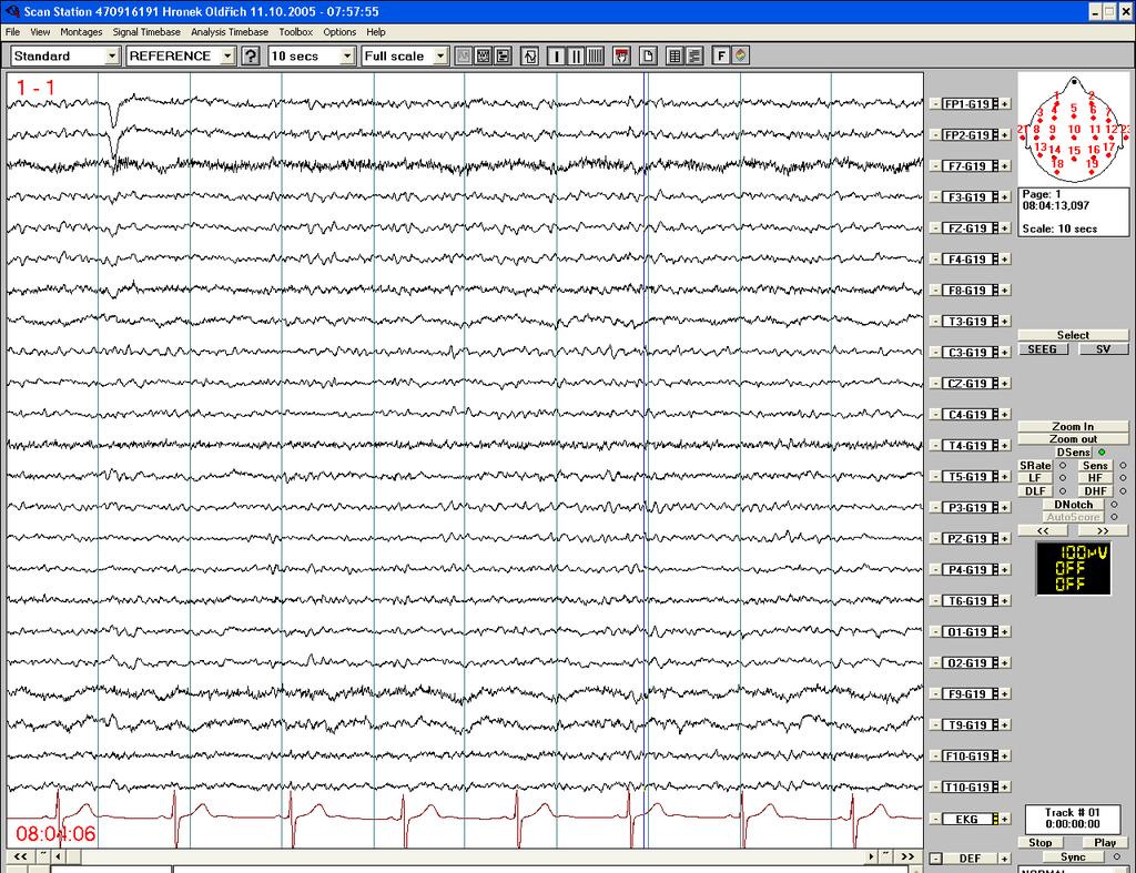 Normální EEG - s přídatnými