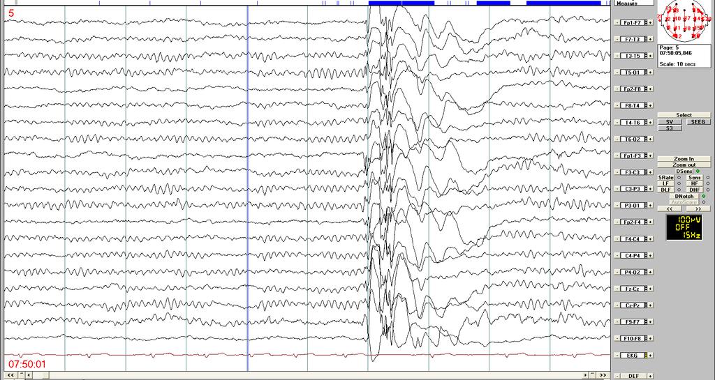 EEG po spánkové