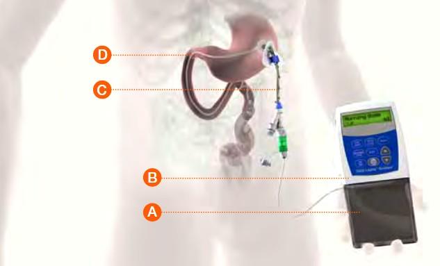 DUODOPA pumpa alternativní způsob aplikace levodopy + carbidopa kontinuální aplikace PEG sondou (perkutální endoskopická gastrostomie) přímo do zažívacího traktu vstup žaludeční stěnou = efektivnější