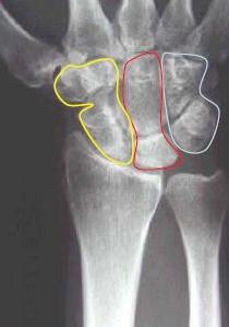 1.6 Nestabilita zápěstí Nestabilita karpu je definována jako abnormální postavení karpálních kůstek způsobené lézí ligament. Nestability obecně rozdělujeme na akutní a chronické.