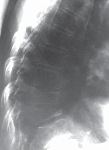 14 Nové léky u postmenopauzální osteoporózy doc. MUDr. Pavel Horák, CSc., MUDr. Martina Skácelová, MUDr. Martin Žurek, MUDr. Andrea Smržová, MUDr. Hana Ciferská III.