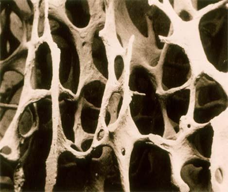 mikroarchitektury kosti, což je příčinou zvýšené lomivosti