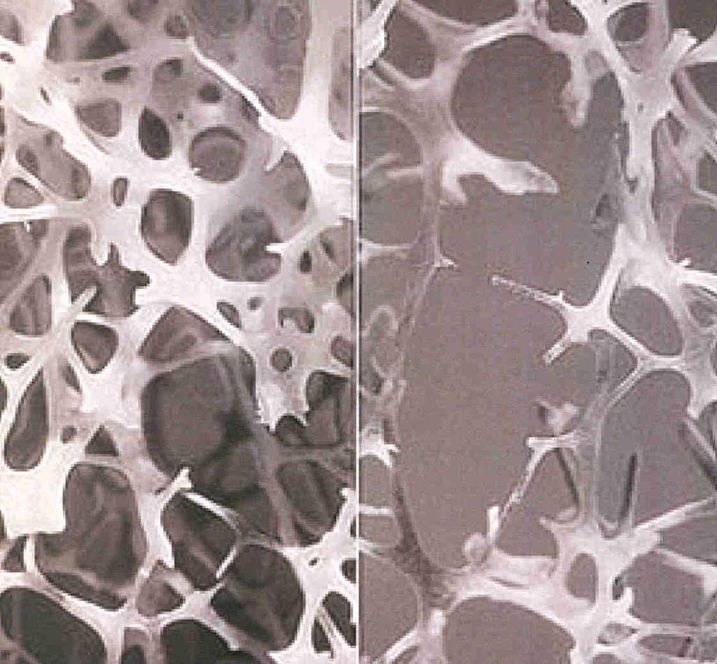 Změny kostní mikroarchitektury při osteoporóze v čase Trabekulární kost (trámčitá) Kostní objem Tloušťka trabekul Počet