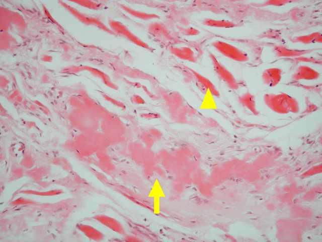 Amyloidóza (2) ukladanie patologických misfolded Bi / fragmetov Bi porucha štruktúry a funkcie tkaniva 1.