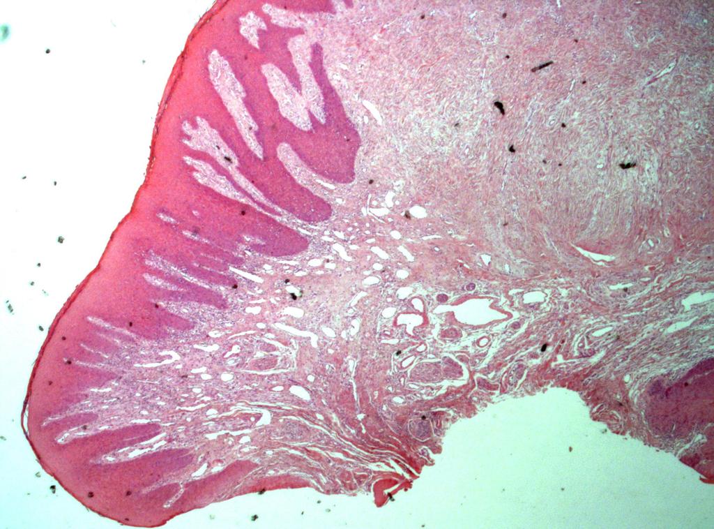 Granuloma fissuratum (280) hyperplázia epitelu