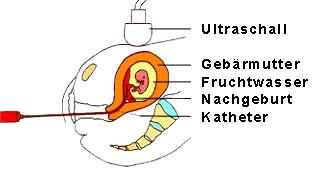Prenatální diagnostika Pod kontrolou ultrazvukem se odebere buď plodová vod amniocentéza (vlevo), nebo vzorek z choriových klků