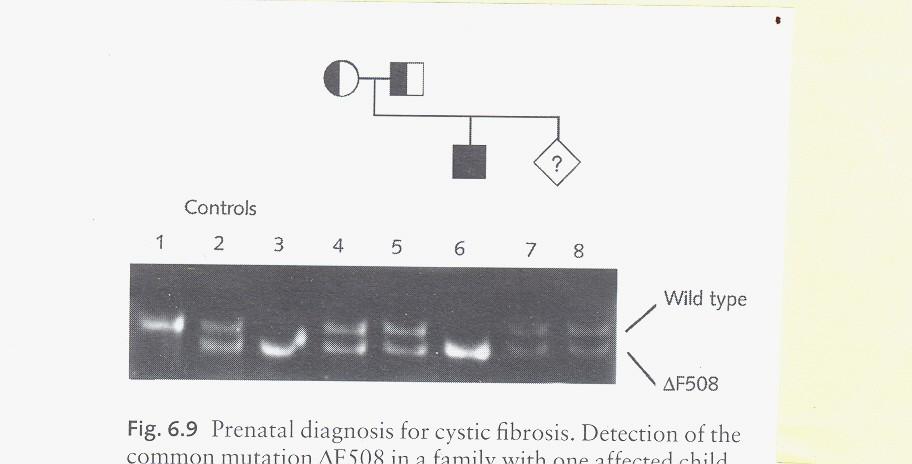 Prenatální diagnosa cystické fibrosy pomocí PCR a gelové elektroforesy.