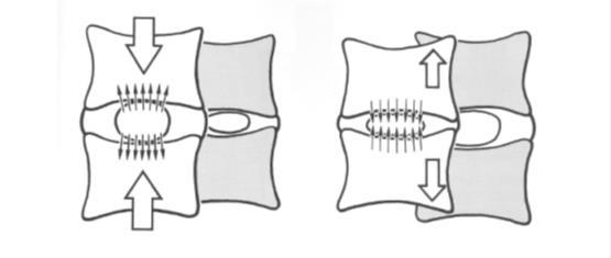 Obr. 6: Proudění tekutin v meziobratlovém disku při zatížení a odlehčení Z hlediska biomechanického rozlišujeme statické a dynamické zatížení disku.