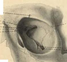 Fissura orbitalis inferior. Sulcus iníraorbitalis.