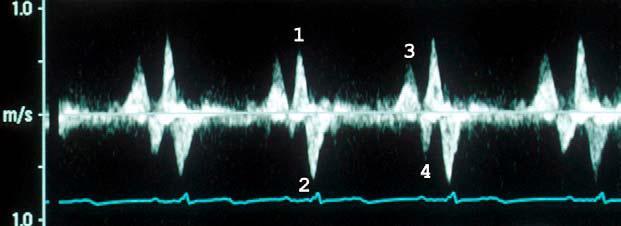 Maerz (2005): Doppler echocardiographic assessment of