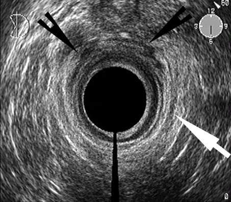 komprese zadní poševní stěny směrem na perineum se roztržené konce EAS snáze vizualizují vzhledem ke své echogenitě a je možno pozorovat hypoechogenní defekt mezi konci roztrženého EAS na rozdíl od