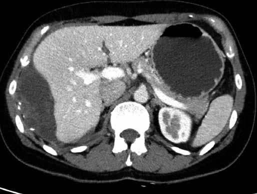 Obr. 4A Obr. 4C Obr. 4B Obr. 4. CT břicha postkontrastně v roce 2015.